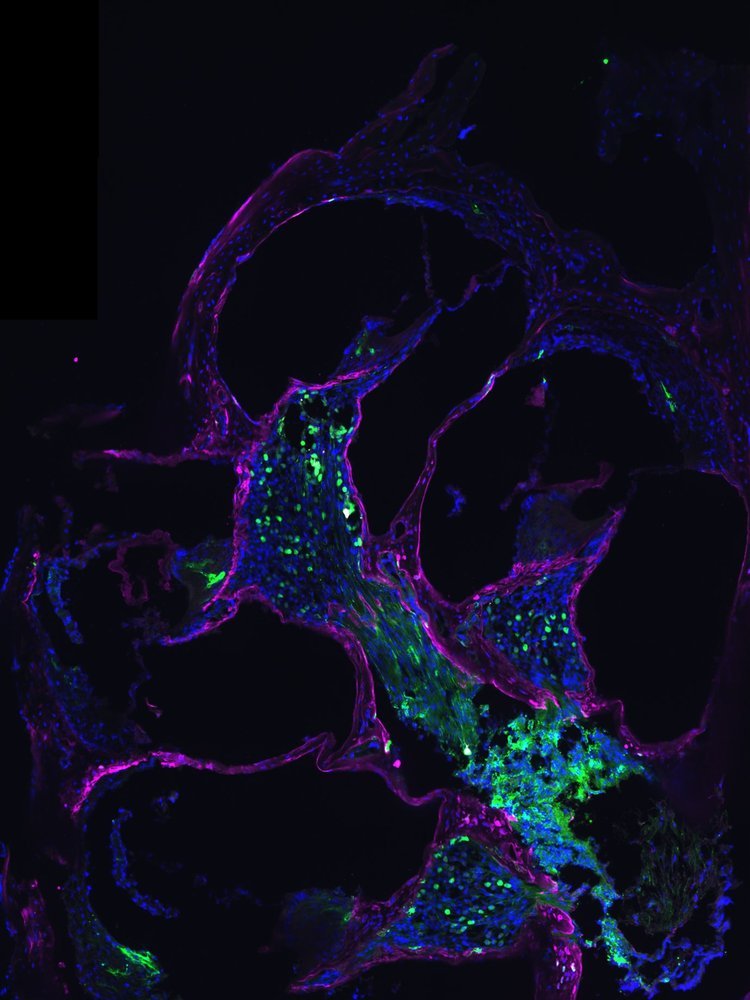 A slice through a cochlea after gene therapy (green) shows replaced norrin protein in pink / magenta.