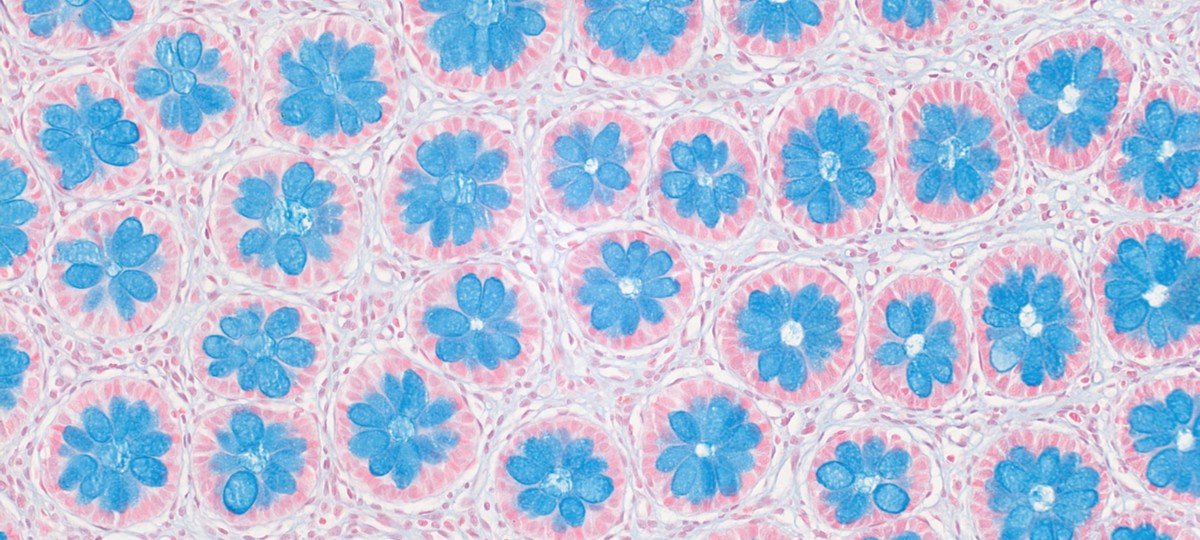 Winner of the 2025 GOSH research image competition. This floral image shows the colon of a patient with Hirschsprung disease, a rare childhood bowel disease.