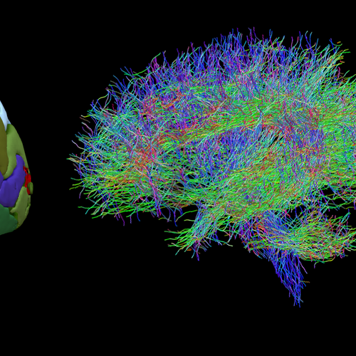 Structural imagine of the brain’s regions (left) and diffusion diagram of the wiring of a brain (right), which Aswin Chari and his team analyse together to create a ’network’